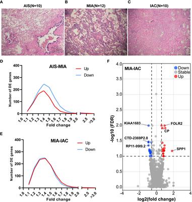 Immune microenvironment analysis and novel biomarkers of early-stage lung adenocarcinoma evolution